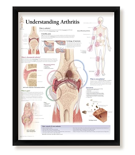 Understanding Arthritis Framed Medical Educational Poster Informational Diagram Doctors Office School Classroom 22x28 Inches